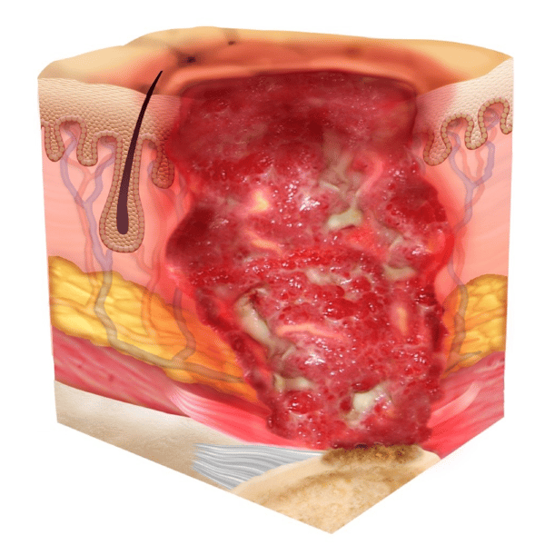 Pressure Injury 101 The 4 Stages